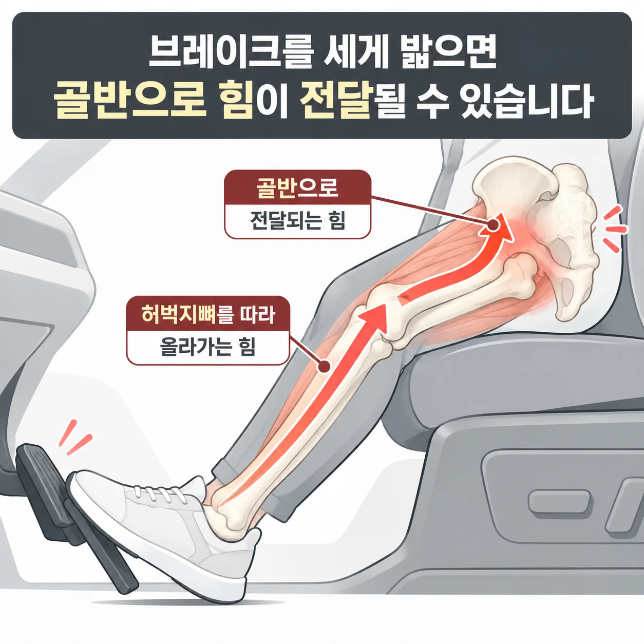 충돌 직전 브레이크를 밟아 버틴 쪽 허벅지를 따라 골반 한쪽으로 힘이 실리는 경로 도식