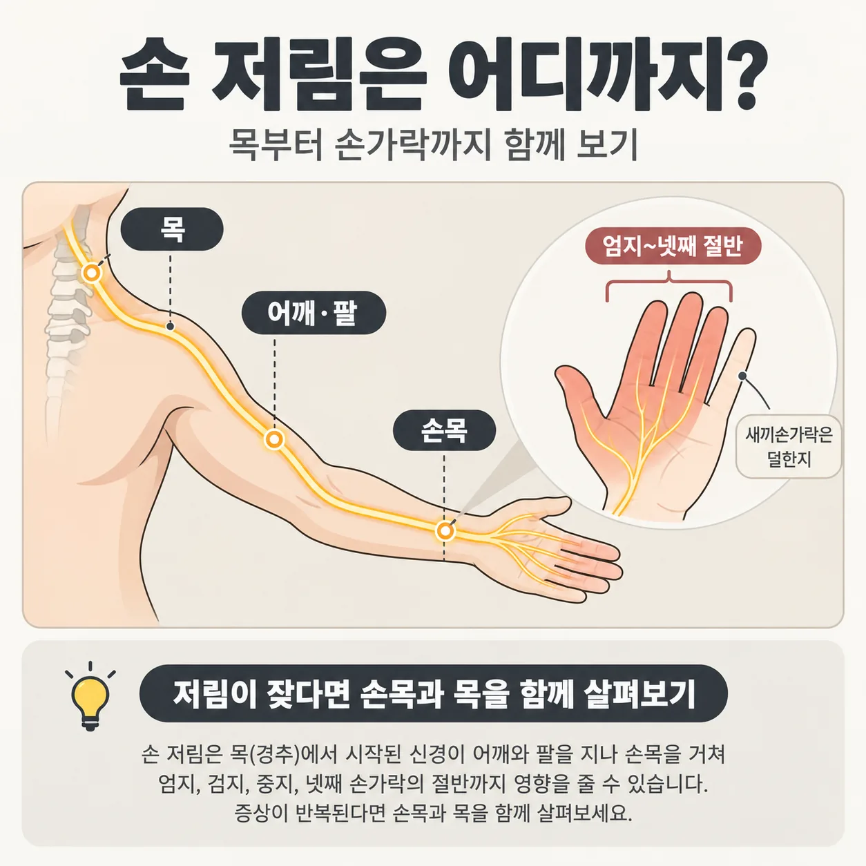 목에서 손가락까지 이어지는 신경 길과 손가락 저림 범위를 표시한 개념도
