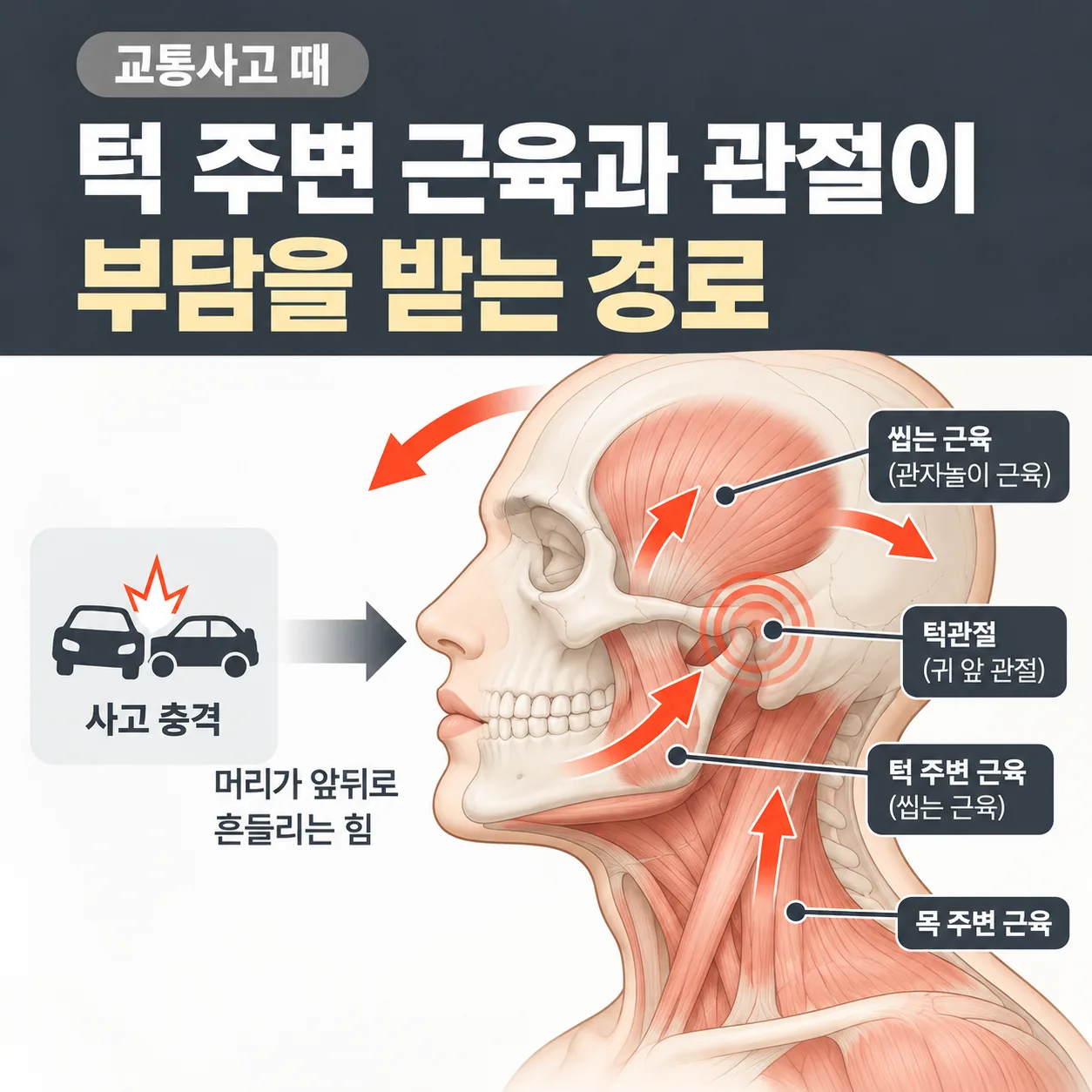 교통사고 때 턱 주변 근육과 관절이 부담을 받는 경로 도식